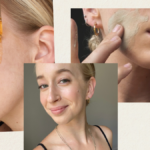 acne journey, skincare