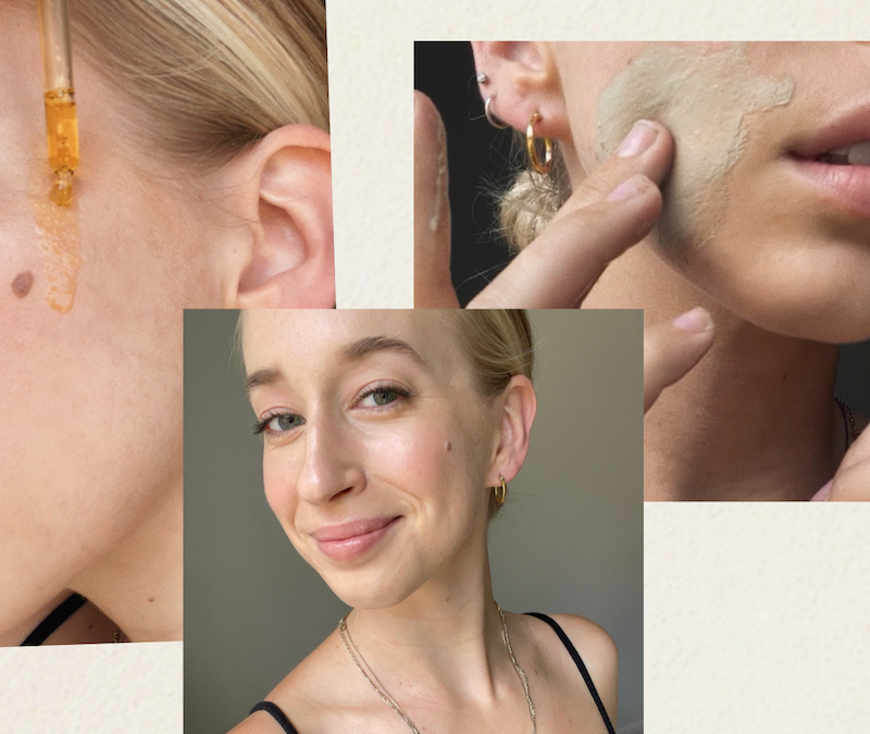 acne journey, skincare