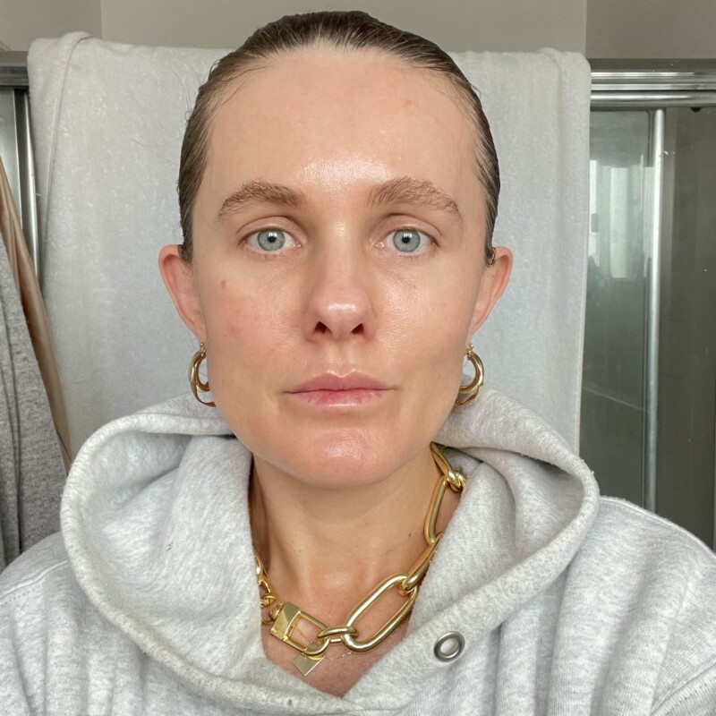 what is microneedling with prp_sacha strebe