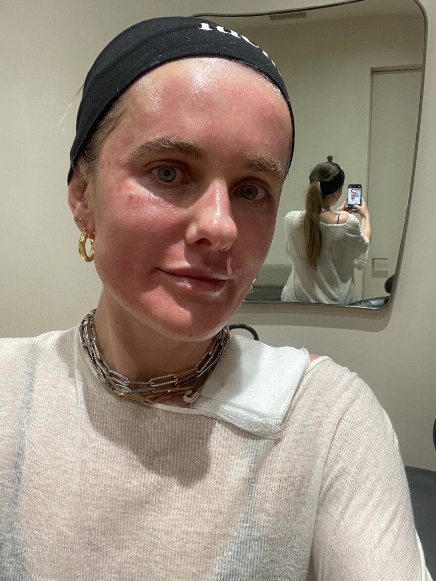 what is microneedling with prp_Sacha Strebe