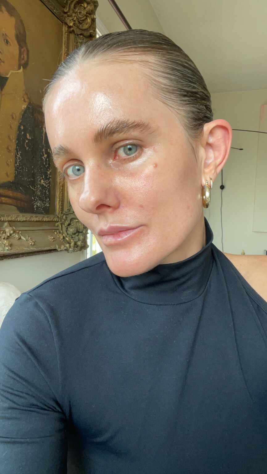 what is microneedling with prp_Sacha Strebe