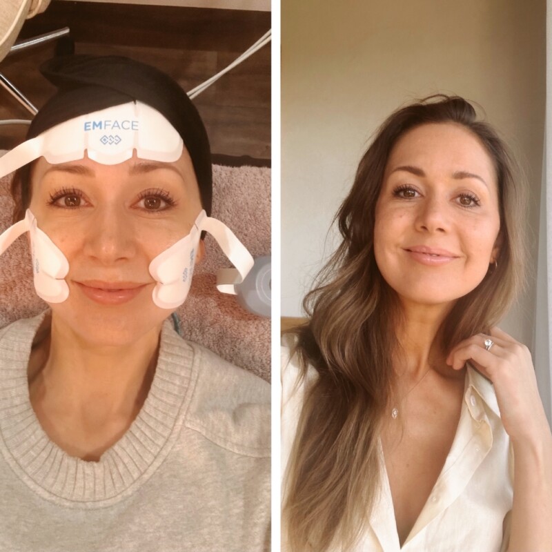 Emface review-before and after